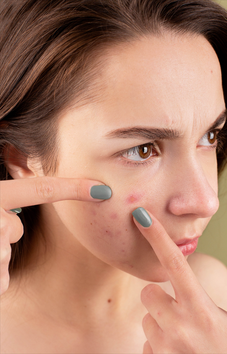 How Cannabidiol (CBD) Works for Your Skin Issues